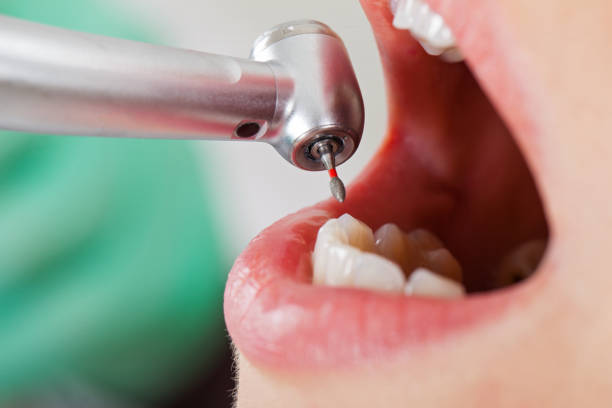Best Emergency Dentist for Knocked-Out Tooth in Stonegate, CO